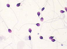 Morphologie der Samenzellen-BRED-015, die Kit Diff Quik Rapid Staining-Methode befleckt